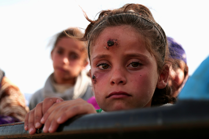 シリアで流行した皮膚が溶ける 奇病 のワクチン開発に光が ニューズウィーク日本版 オフィシャルサイト