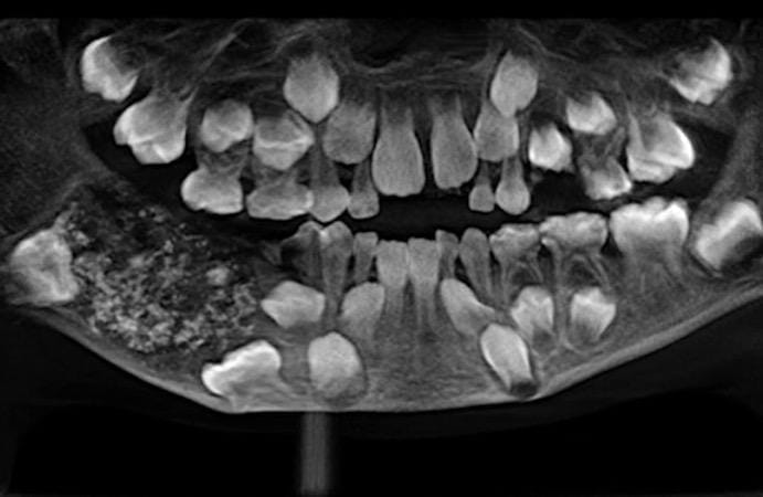 インドで 7歳男児の口内から526本の歯が摘出される ワールド 最新記事 ニューズウィーク日本版 オフィシャルサイト