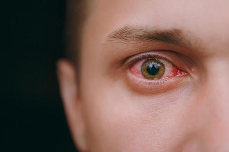新型コロナウイルス感染症で 目が痛む 人が増えている ニューズウィーク日本版 オフィシャルサイト