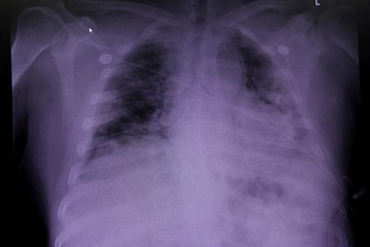 新型コロナ死亡患者 肺に重度の損傷 症状 長期化 の原因か ワールド 最新記事 ニューズウィーク日本版 オフィシャルサイト