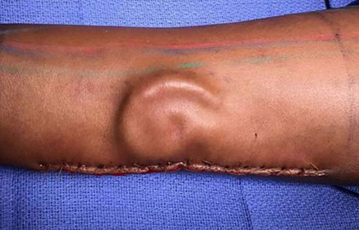 左耳を失った米女性兵士 前腕で育てた耳の移植手術に成功 ワールド 最新記事 ニューズウィーク日本版 オフィシャルサイト